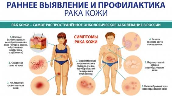 Эксперты Ростовского онкоцентра рассказали, как найти признаки рака кожи