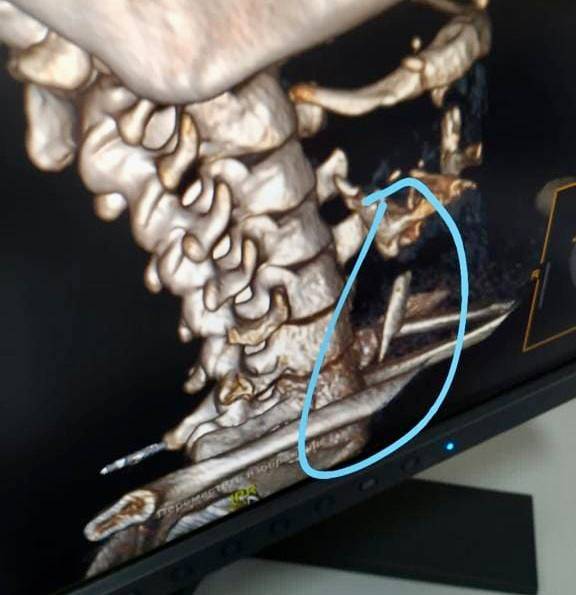Проглотившую шашлык с костью 38-летнюю ростовчанку спасли врачи БСМП