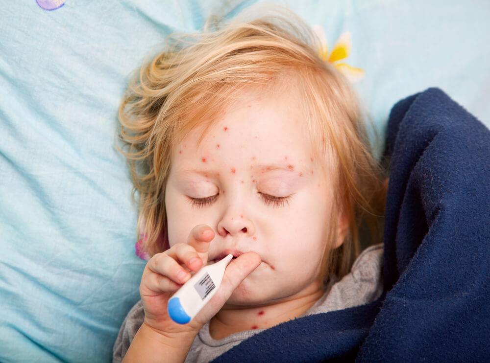 На Дону начинают массовую вакцинацию от кори из-за появления заболевших